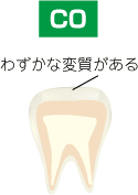 虫歯　C0